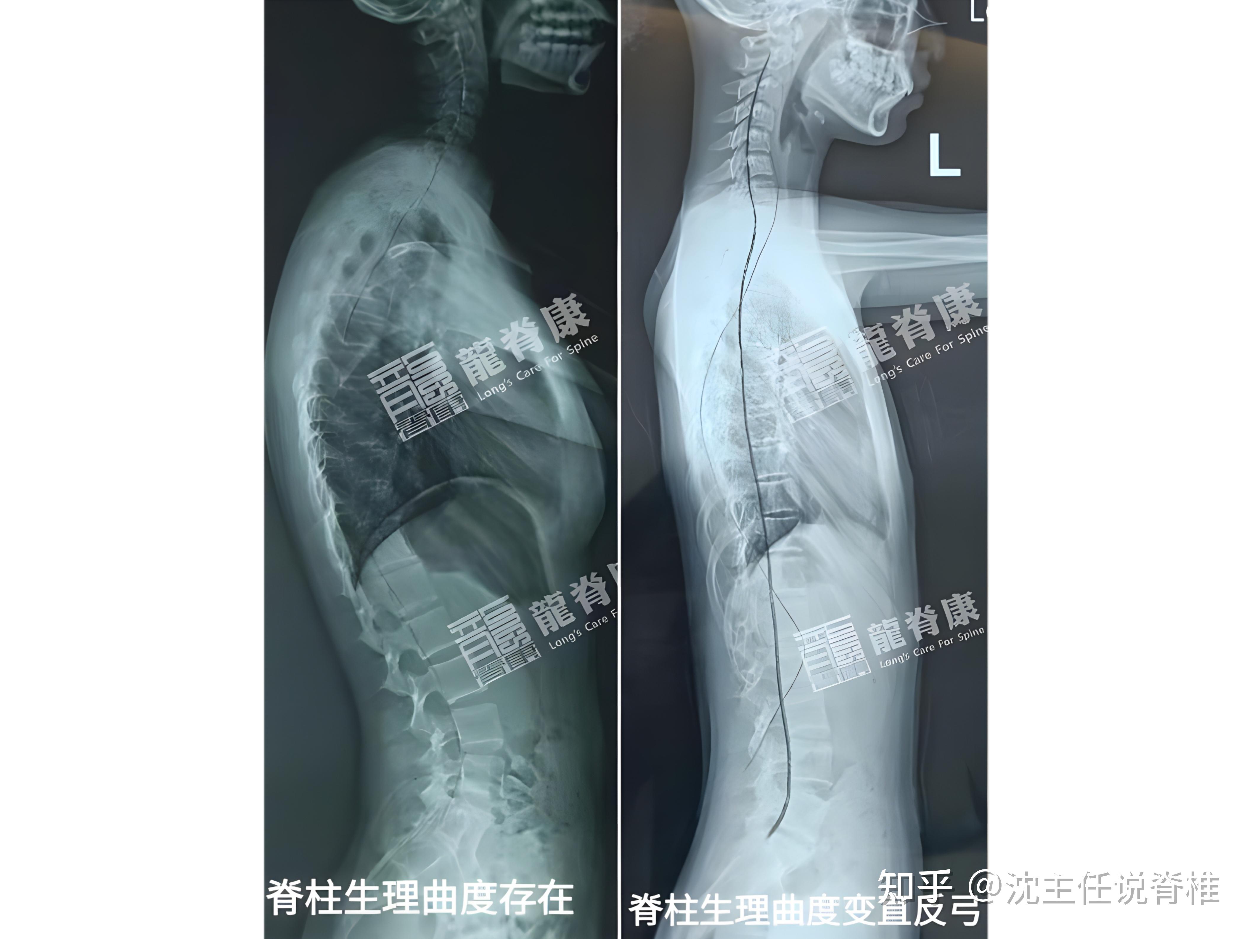 生理曲度变直、反弓,是怎么回事?可以做哪些锻炼? - 知乎