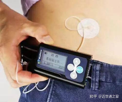 迈世通胰岛素泵报警类型及处理 - 知乎