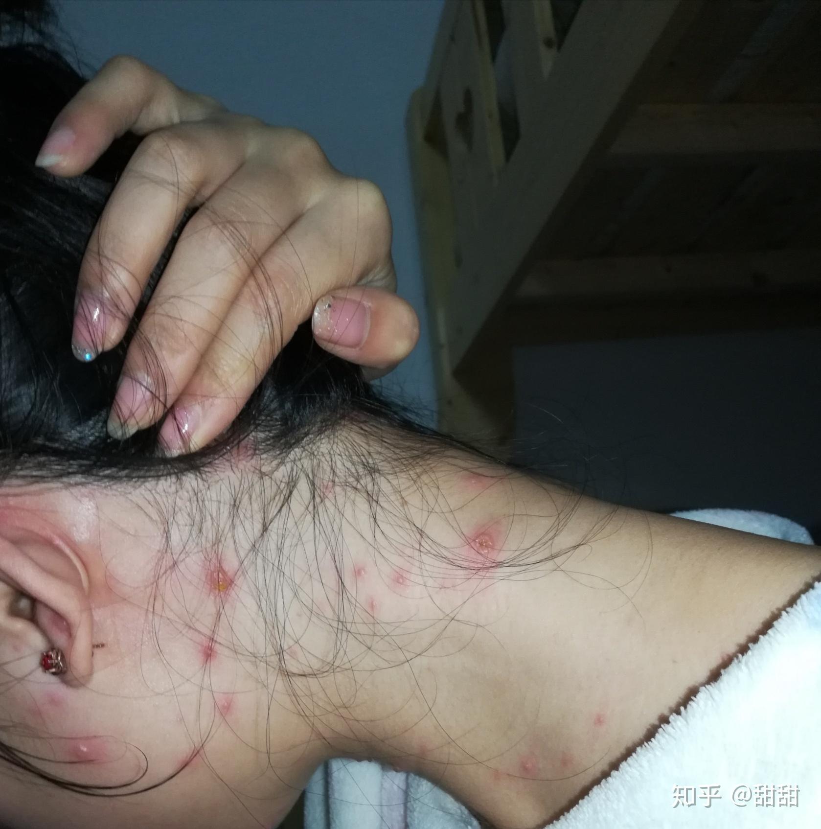 成人长水痘是什么样的经历? - 知乎