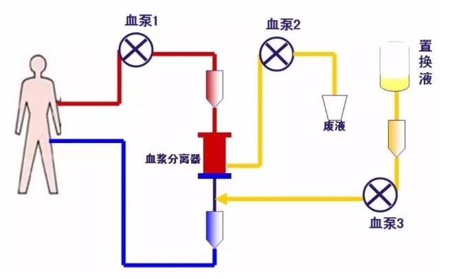 血浆置换的标准操作流程 - 知乎