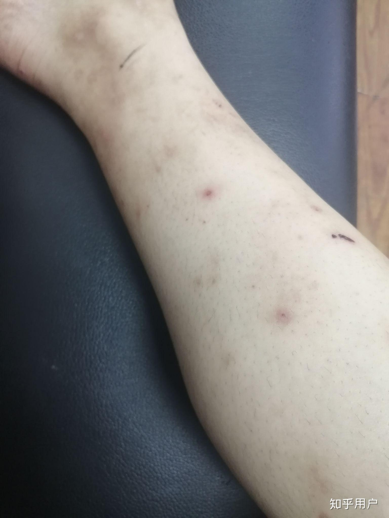 多年湿疹现在18岁腿上手上留下挺多的疤痕有什么办法治疗