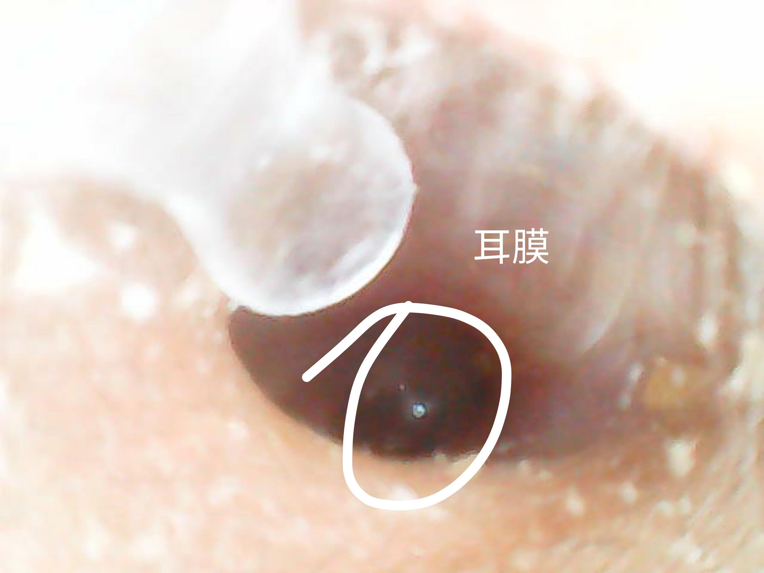 为什么我从来没掏出来过大号的耳耵聍? - 知乎