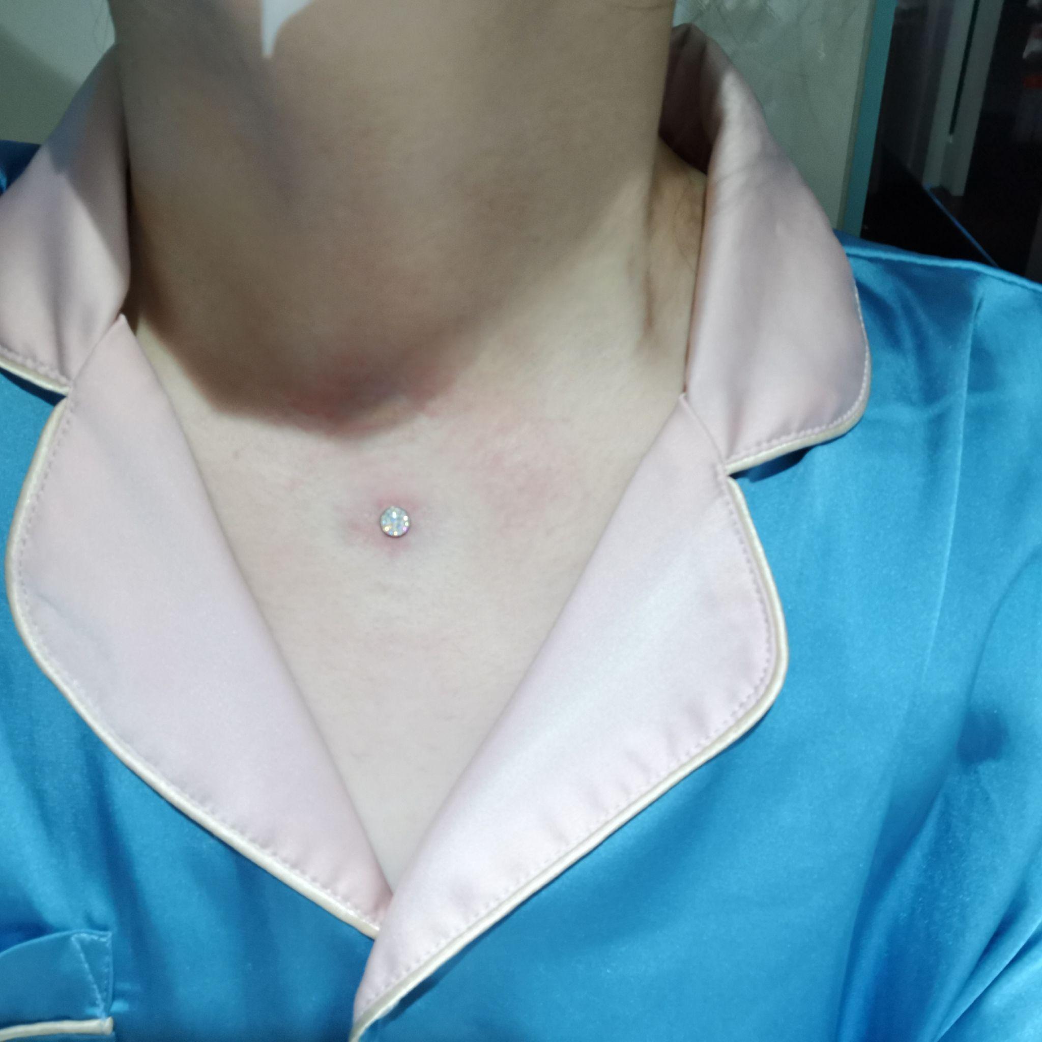 能分享下自己埋钉的经历吗? - 知乎