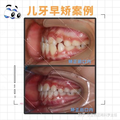 儿童牙齿早期干预戴mrc肌功能矫正器到底什么价位