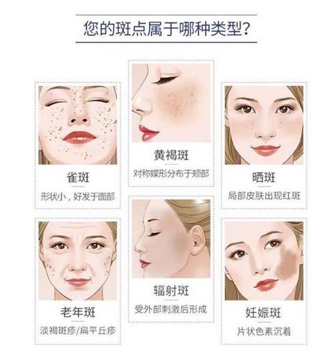 木木木黄褐斑,色斑,雀斑,晒斑,辐射斑,老年斑,这么多斑,都是怎么来的?