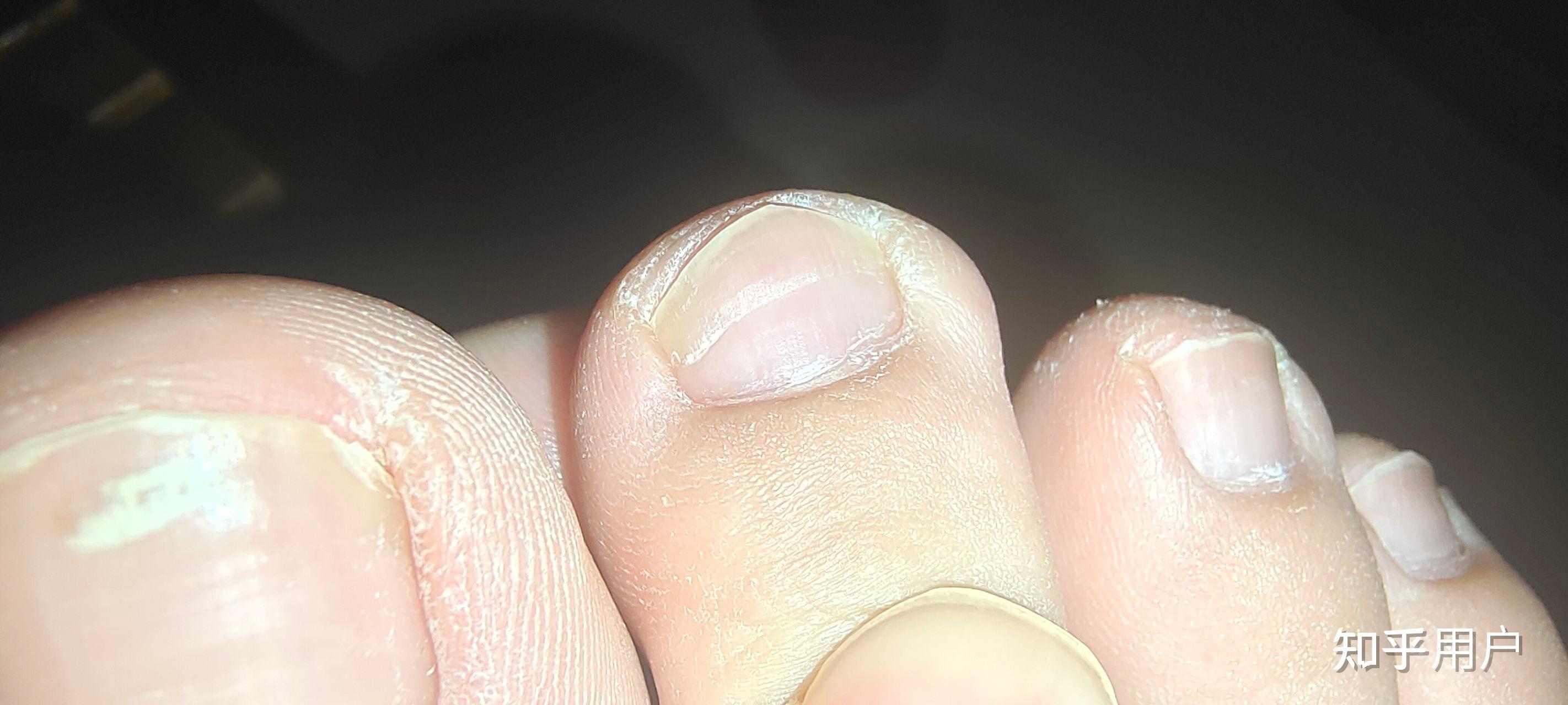 大脚趾甲有一条特别深的横纹,看起来跟裂开了一样,想请教一下这是怎么