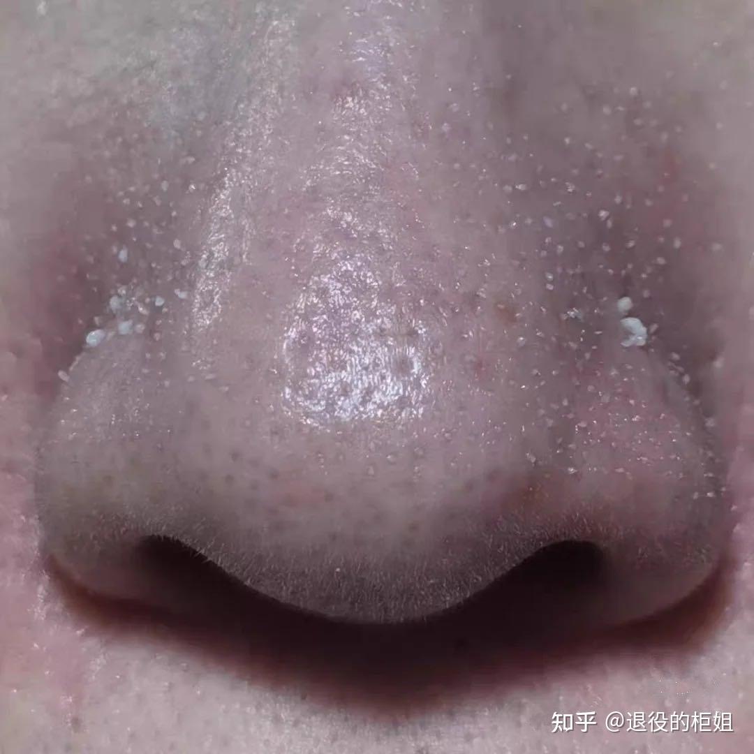 为什么黑鼻头里吸出来的的东西白色的，而在鼻子里看着是黑色的？