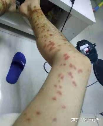 被跳蚤叮了一身包 看不见跳蚤 但是总感觉它在身上
