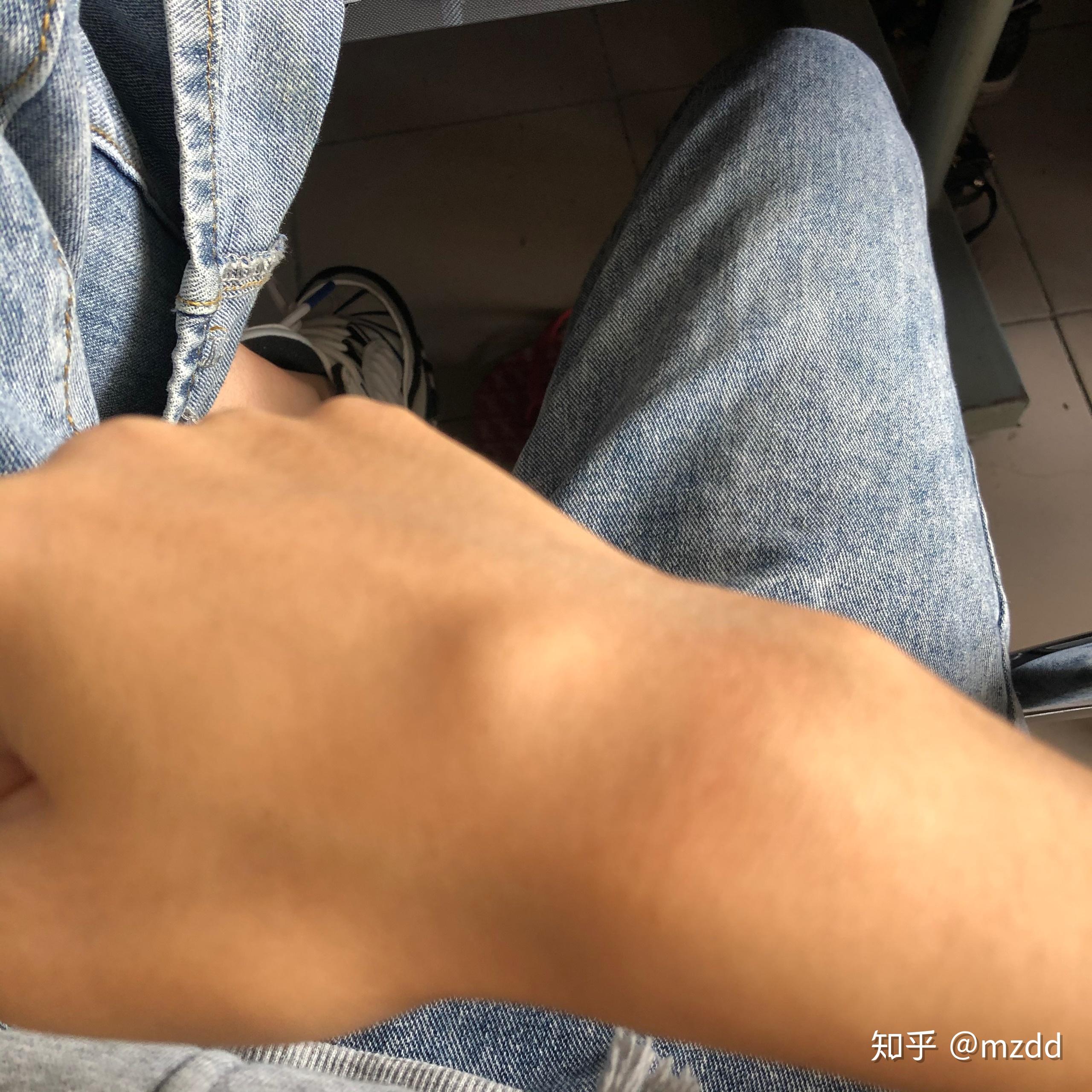 手背腱鞘囊肿能否自愈?