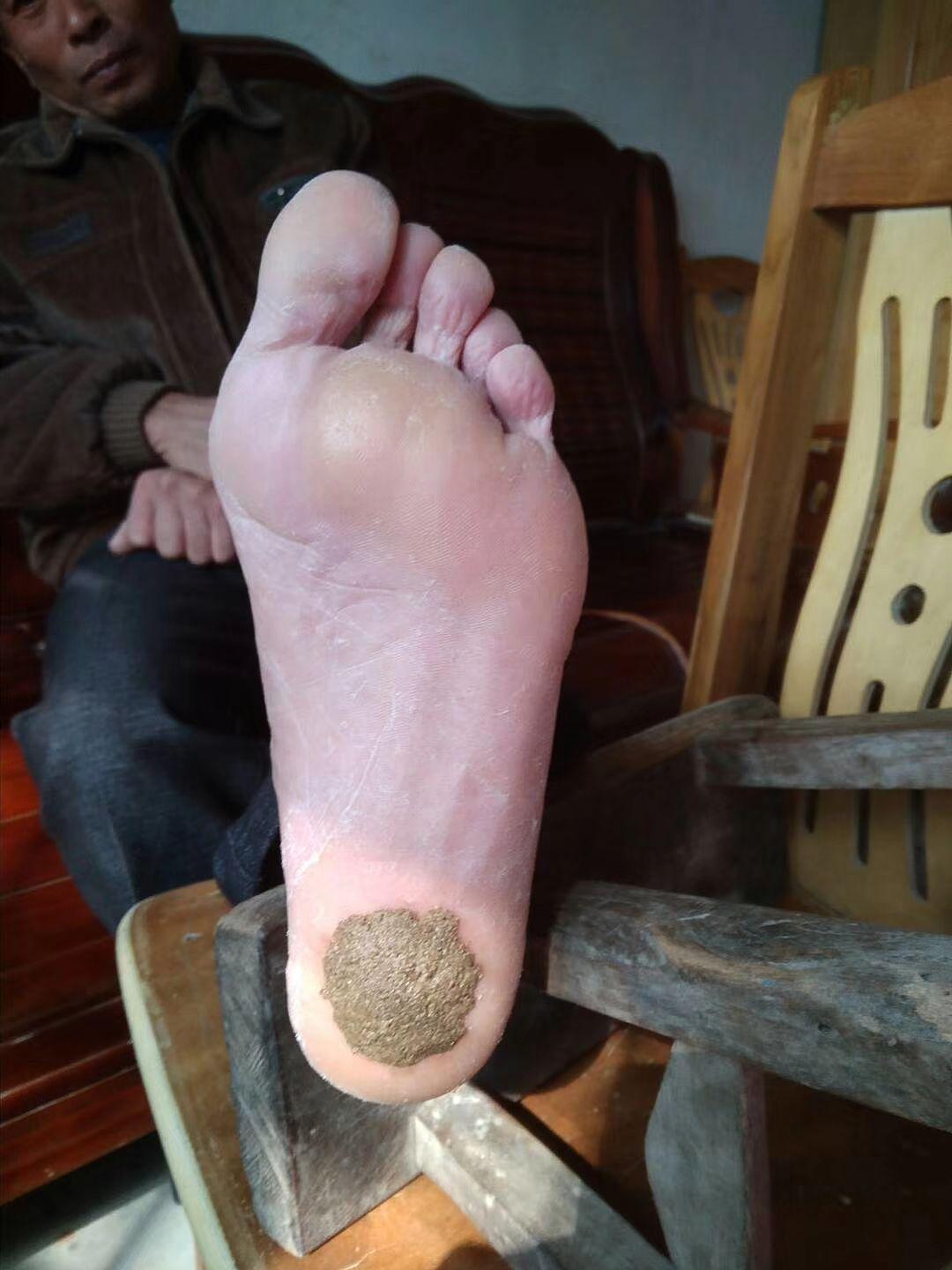 为老父亲跪求一剂治疗足跟骨刺的良药! - 知乎