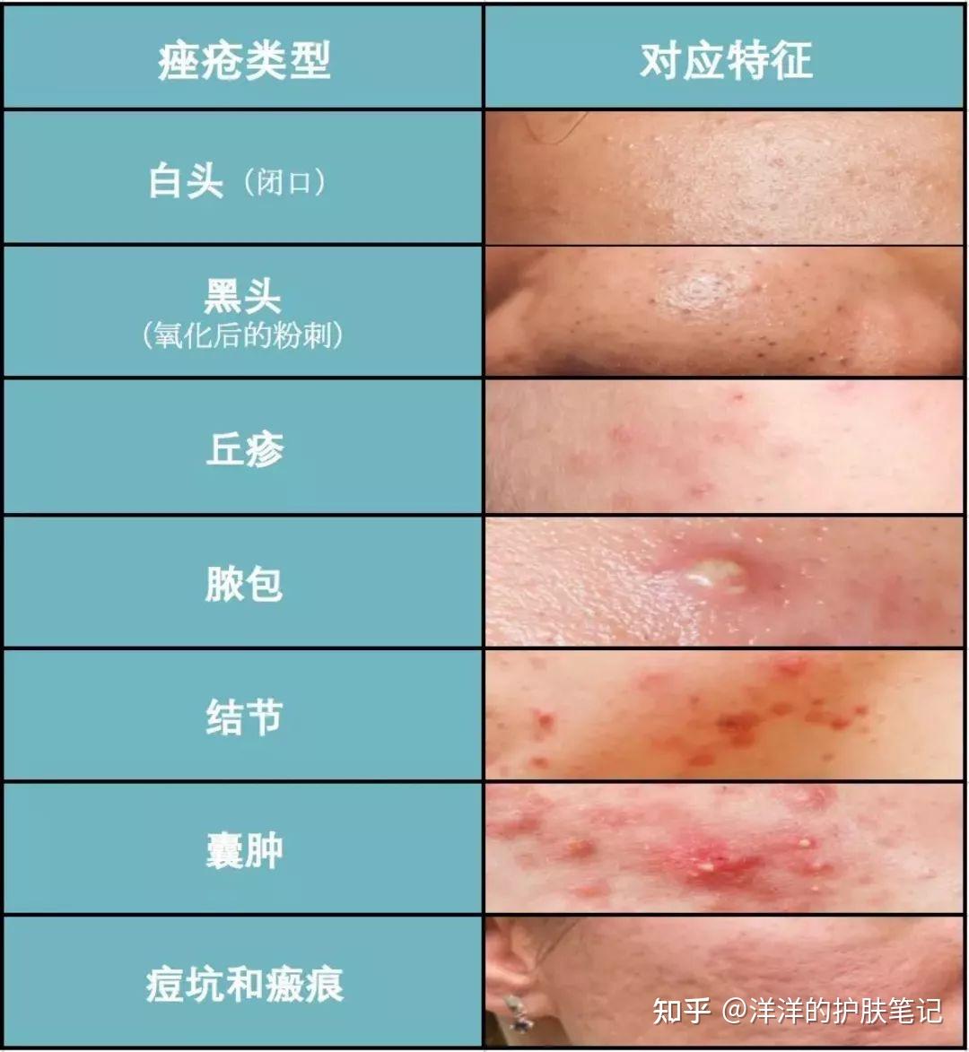 为什么同样的祛痘产品,别人有效我却烂脸? ——皮肤科讲师揭秘:祛痘的“个体差异陷阱” - 知乎