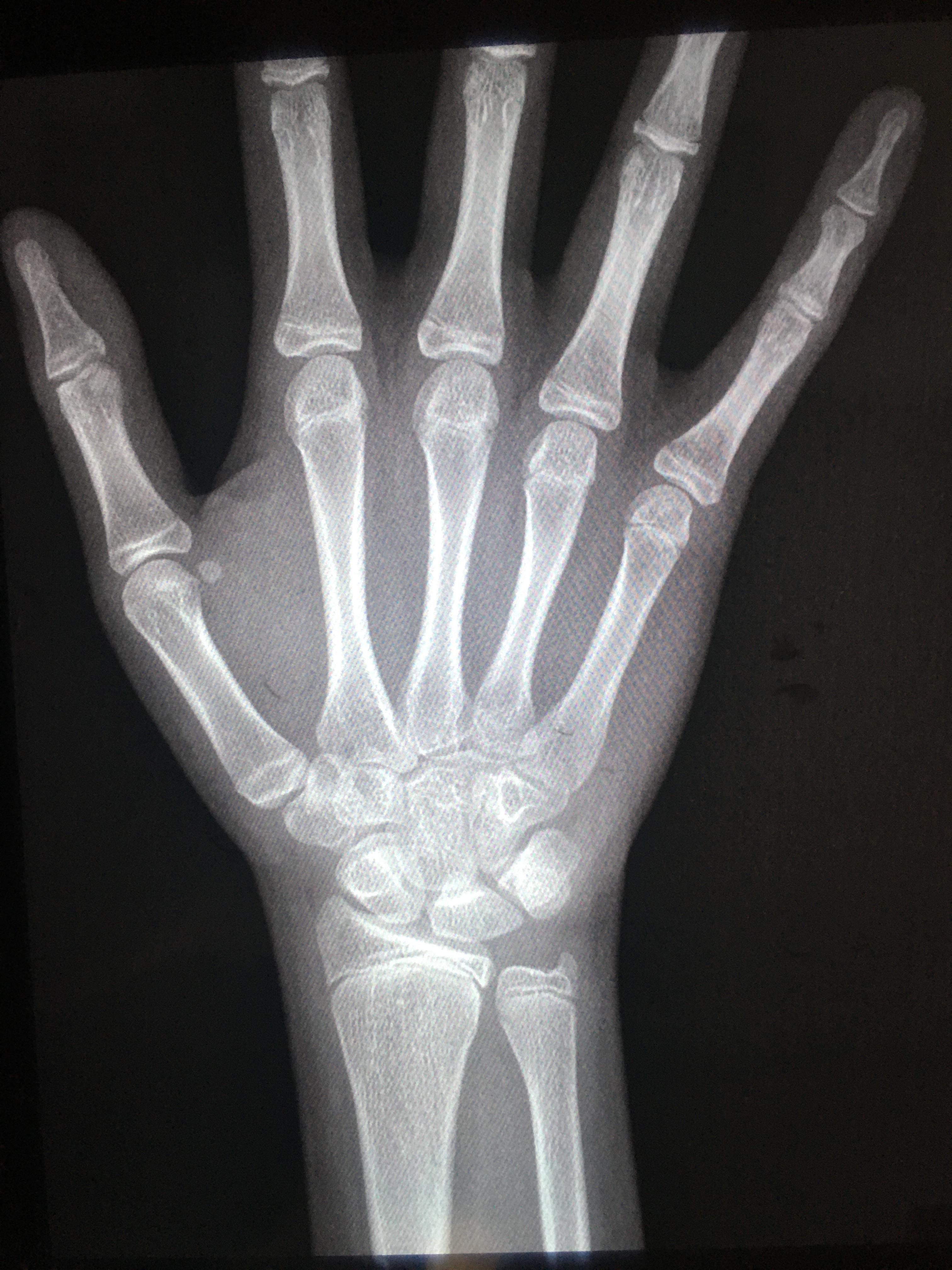 黑,白,手,骨,X射线免费照片-千叶网
