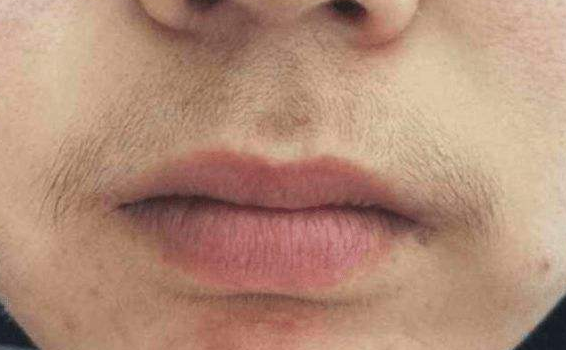 有没有能成功脱唇毛的方法