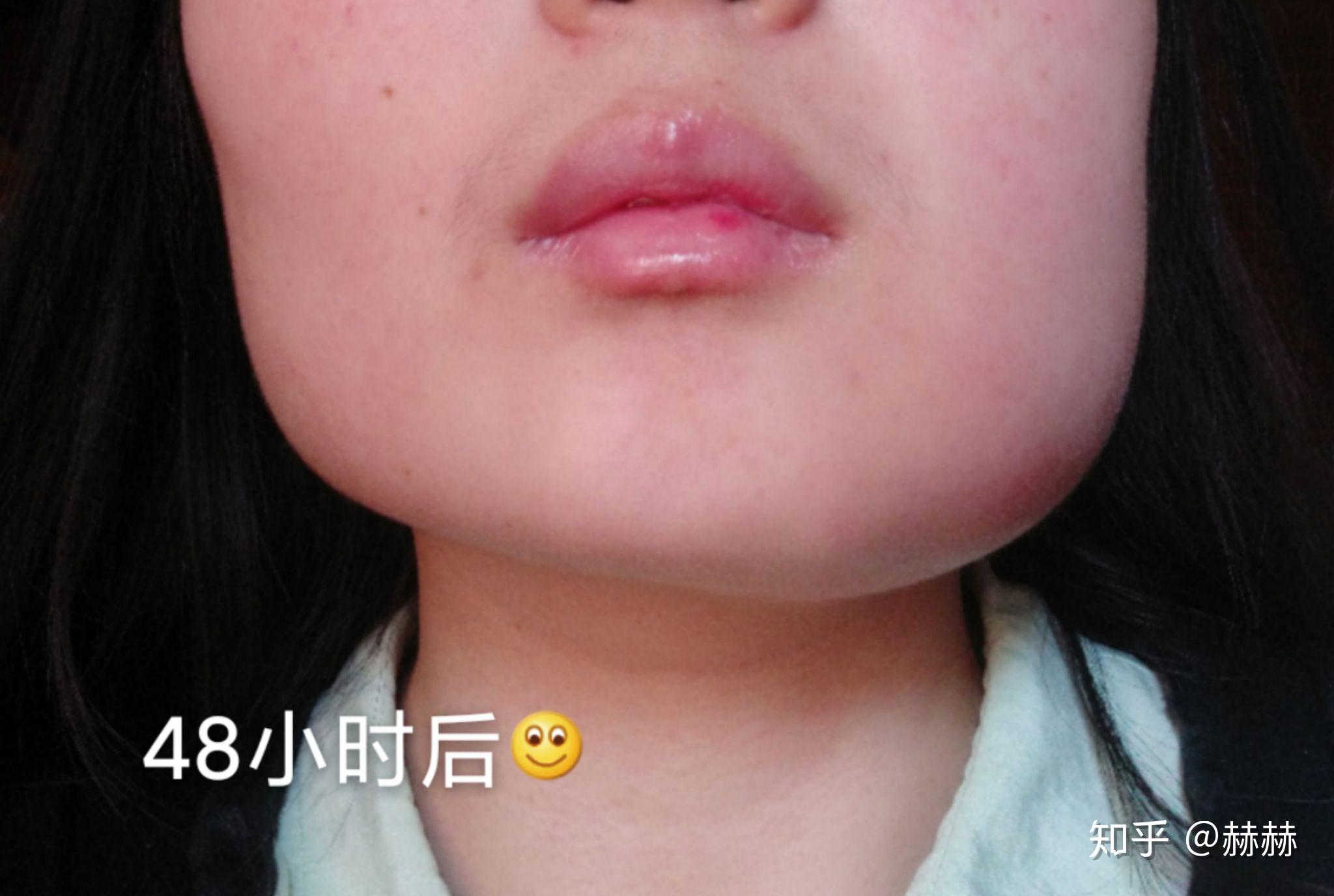 拔水平阻生智齿术后第二天脸肿了请问几天能消肿