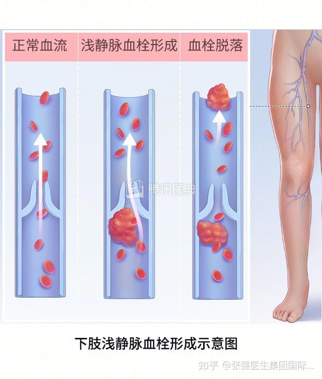 为什么下肢静脉最容易发生血栓形成脱落? - 知乎