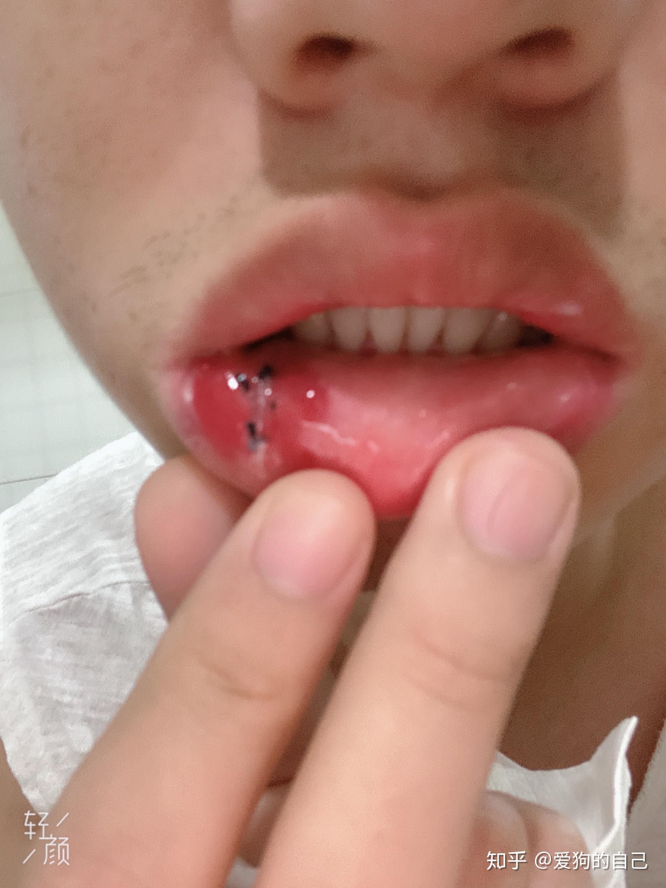 嘴唇粘液腺囊肿手术后? - 知乎