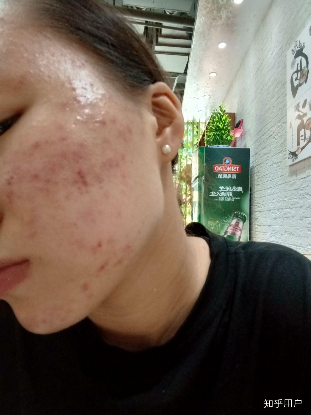 我的痘印两年了有点红褐色还能去除吗求你了各位哥哥和姐姐我17难道