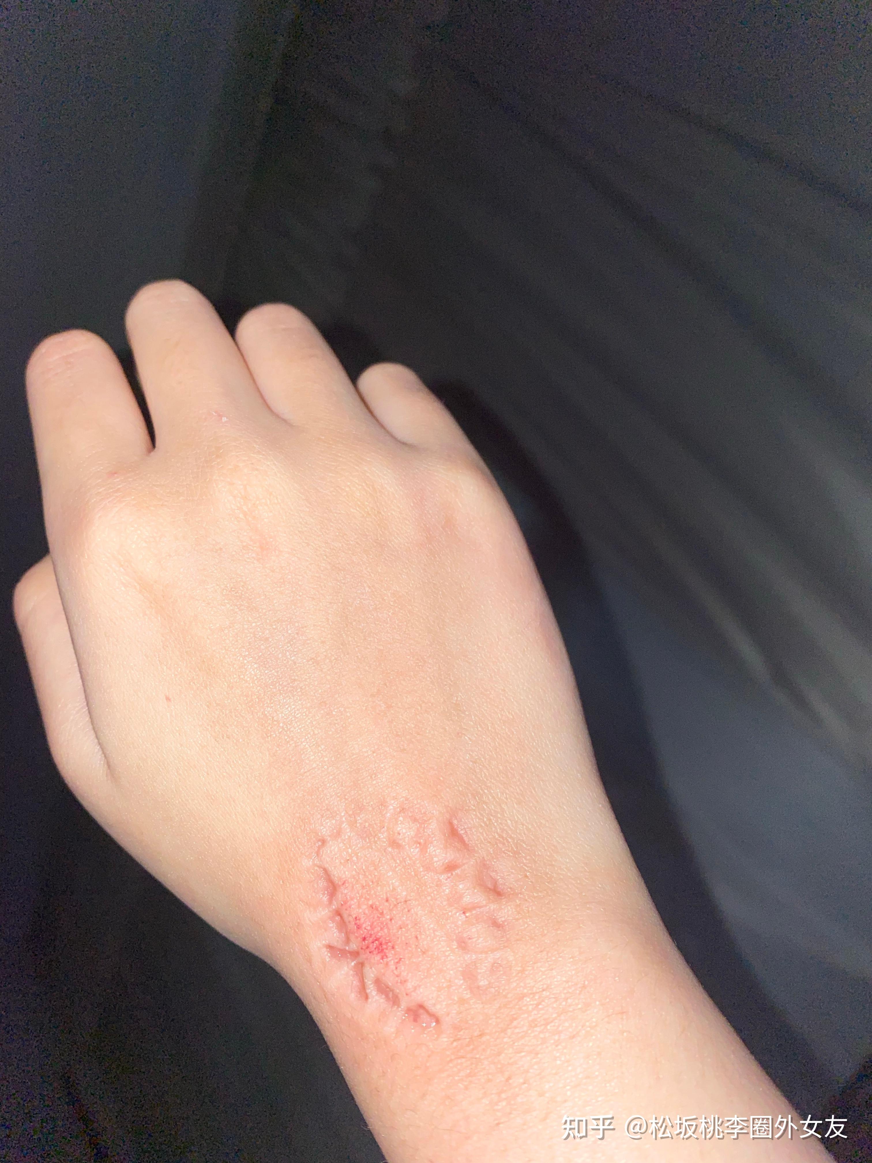 我最近开始喜欢自己咬自己的手臂,并且试图从中获得快感,为什么?