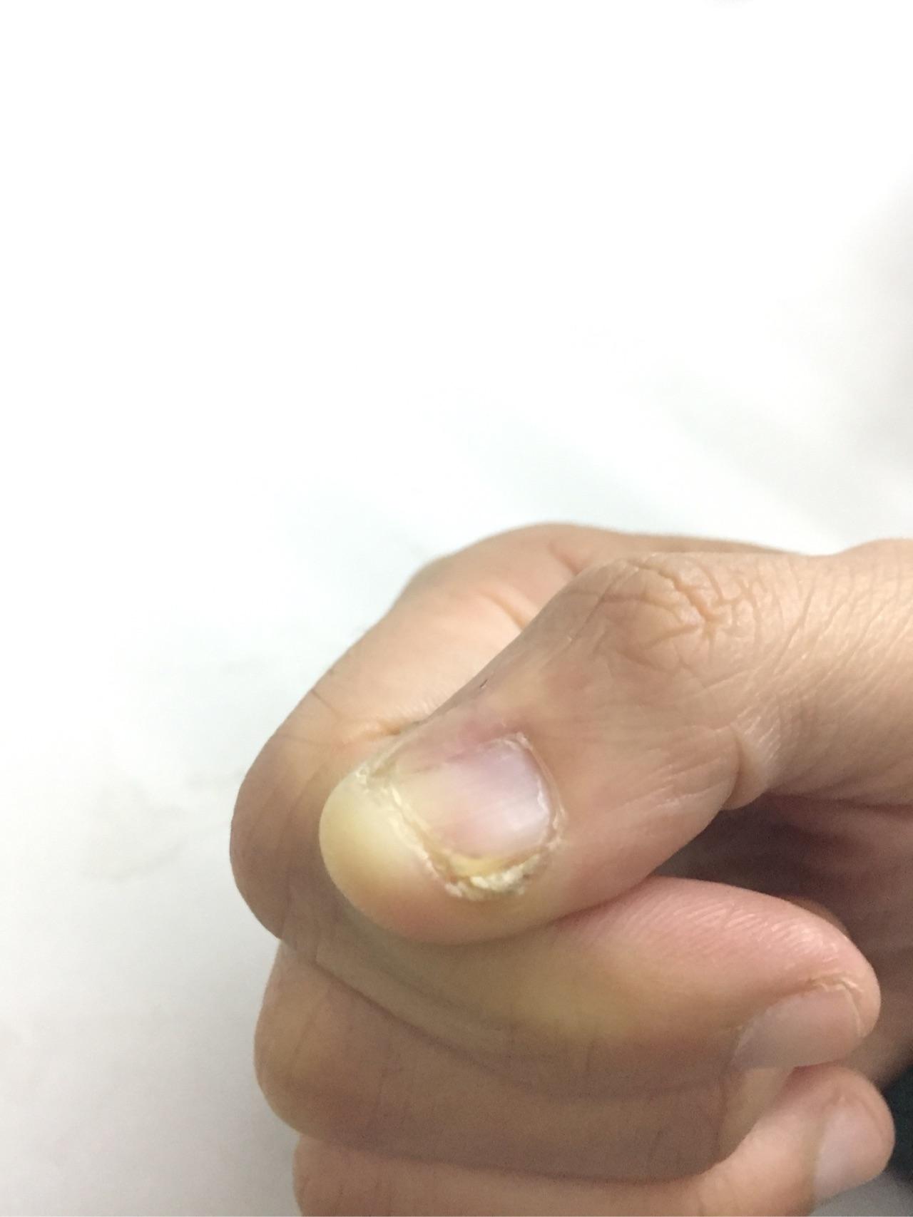 各位大神鄙人手残手指甲旁边长了死皮用指甲刀剪的时候把一些肉也剪了