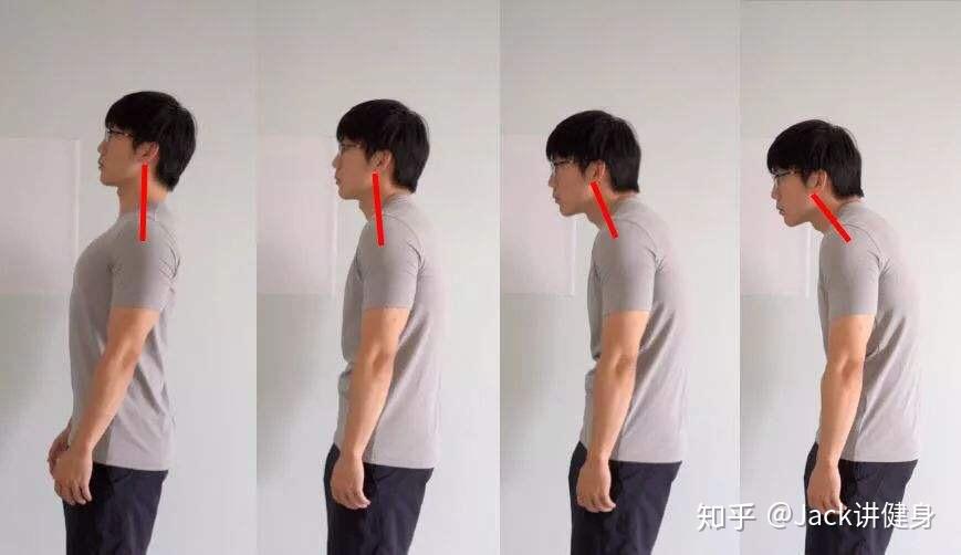 驼背和脊柱侧弯的区别在哪儿?纠正方法有什么不一样吗? - 知乎