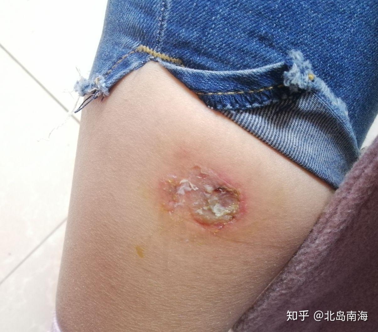 被蜘蛛咬了怎么办!