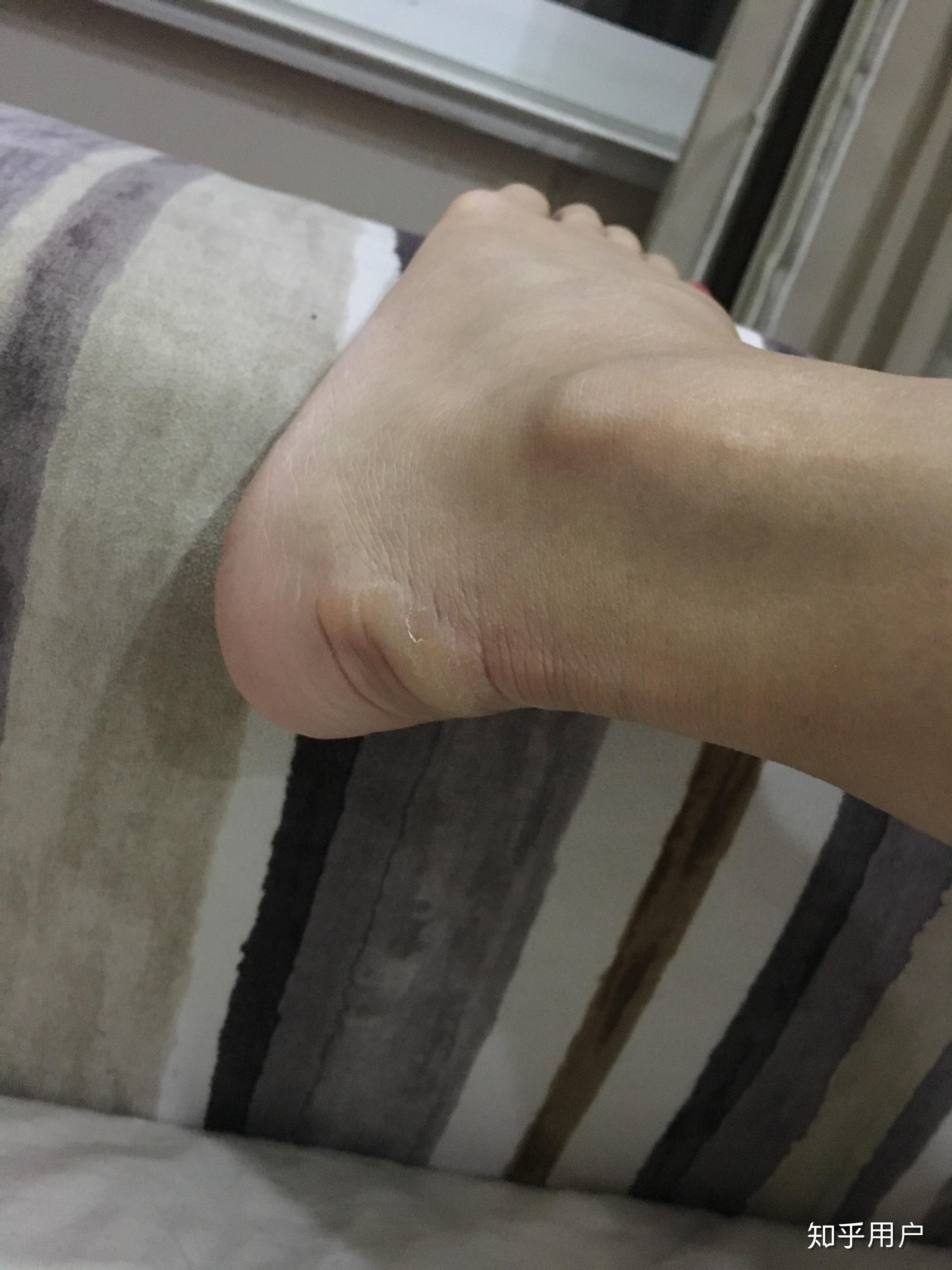 没有脚后跟是一种怎样的体验?怎么解决? - 知乎