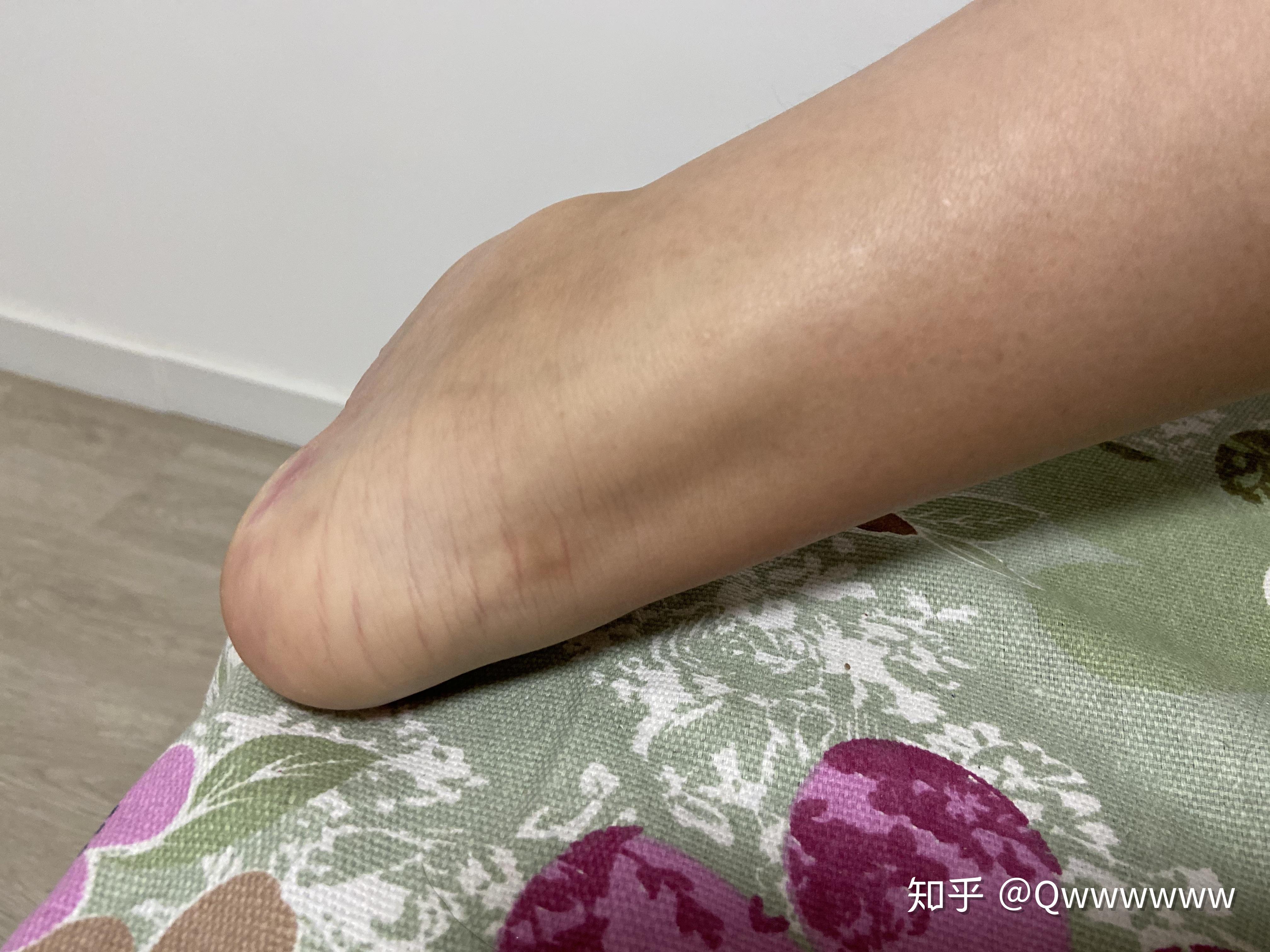 女生脚踝粗是基因决定的吗? - 知乎