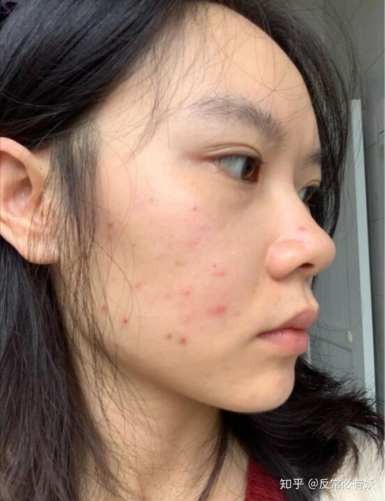 如果你也有一脸痘痘,你会怎么样生活? - 知乎