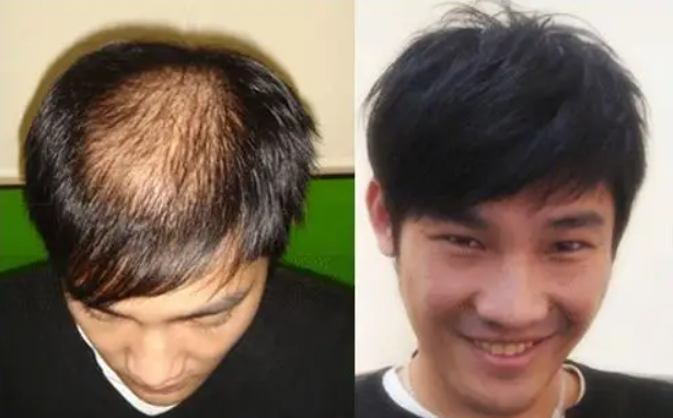 掉发=脱发 自我判断掉发类型和对策 - 知乎