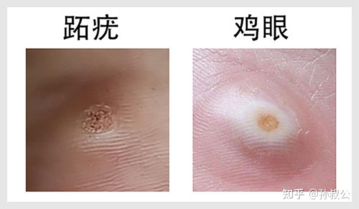 麻烦看一下这是鸡眼吗? - 知乎