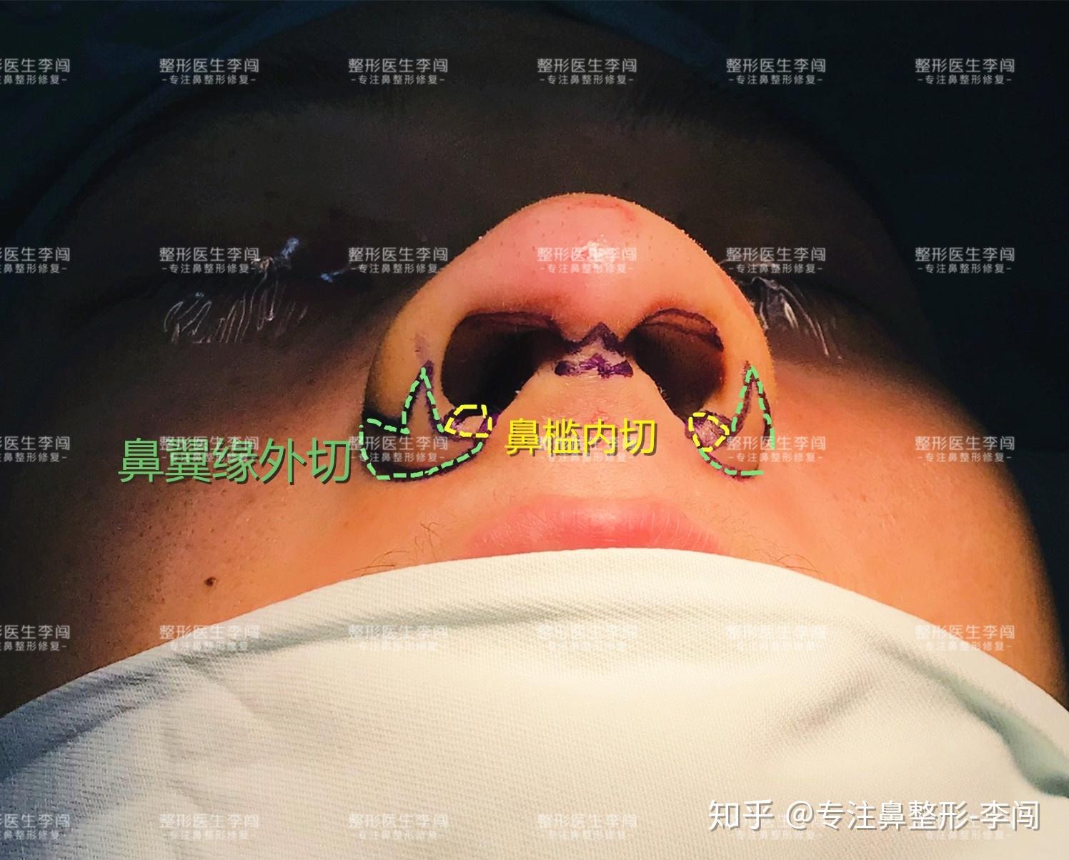 鼻翼缩小的隐藏bug——单纯鼻翼软骨缝合 - 知乎