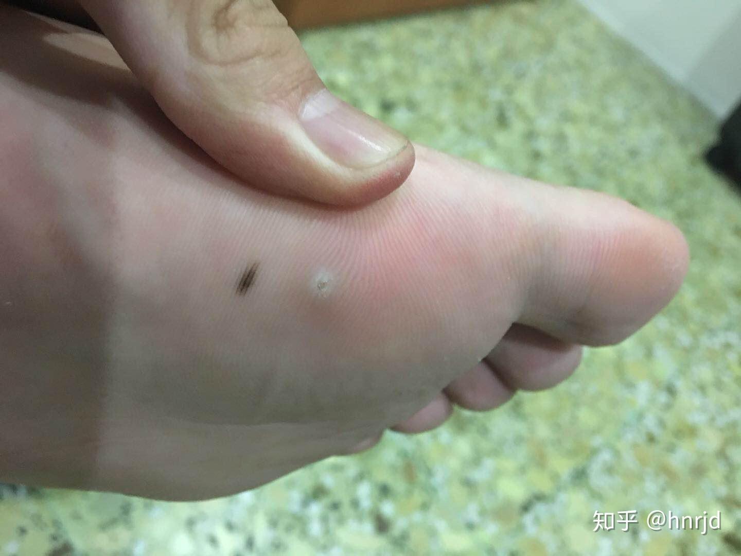 请问脚底长的这种洞洞是什么? - 知乎