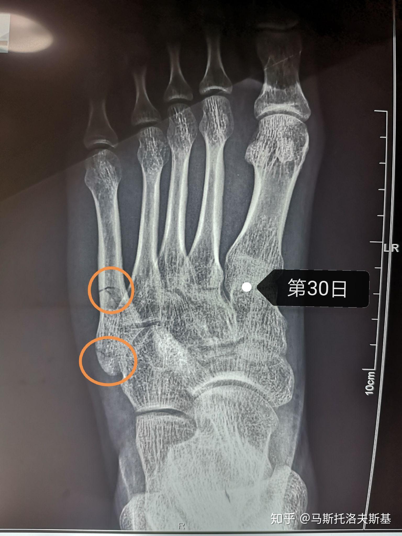 左脚第五跖骨骨折