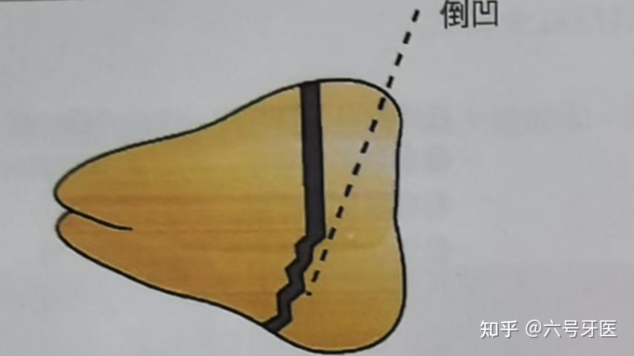 口腔拔牙技巧7——下颌阻生智齿的拔除技巧。 - 知乎