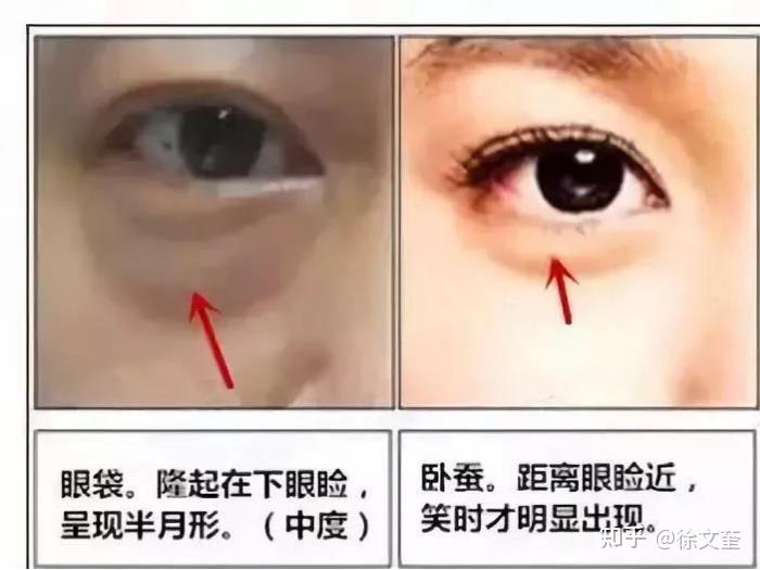 眼袋黑眼圈和卧蚕的区别是什么