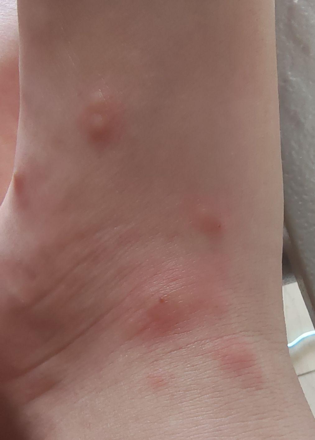 被蚂蚁咬之后用药什么更有效呢?