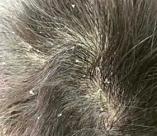 大块大块地掉头皮屑,有什么好用的男士去屑洗发水推荐?