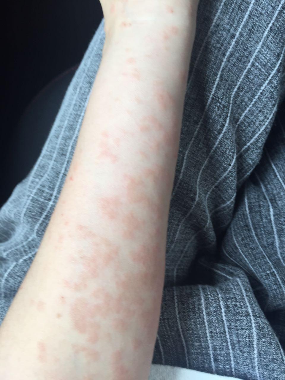 皮肤过敏了百度一下好像是湿疹怎么办啊