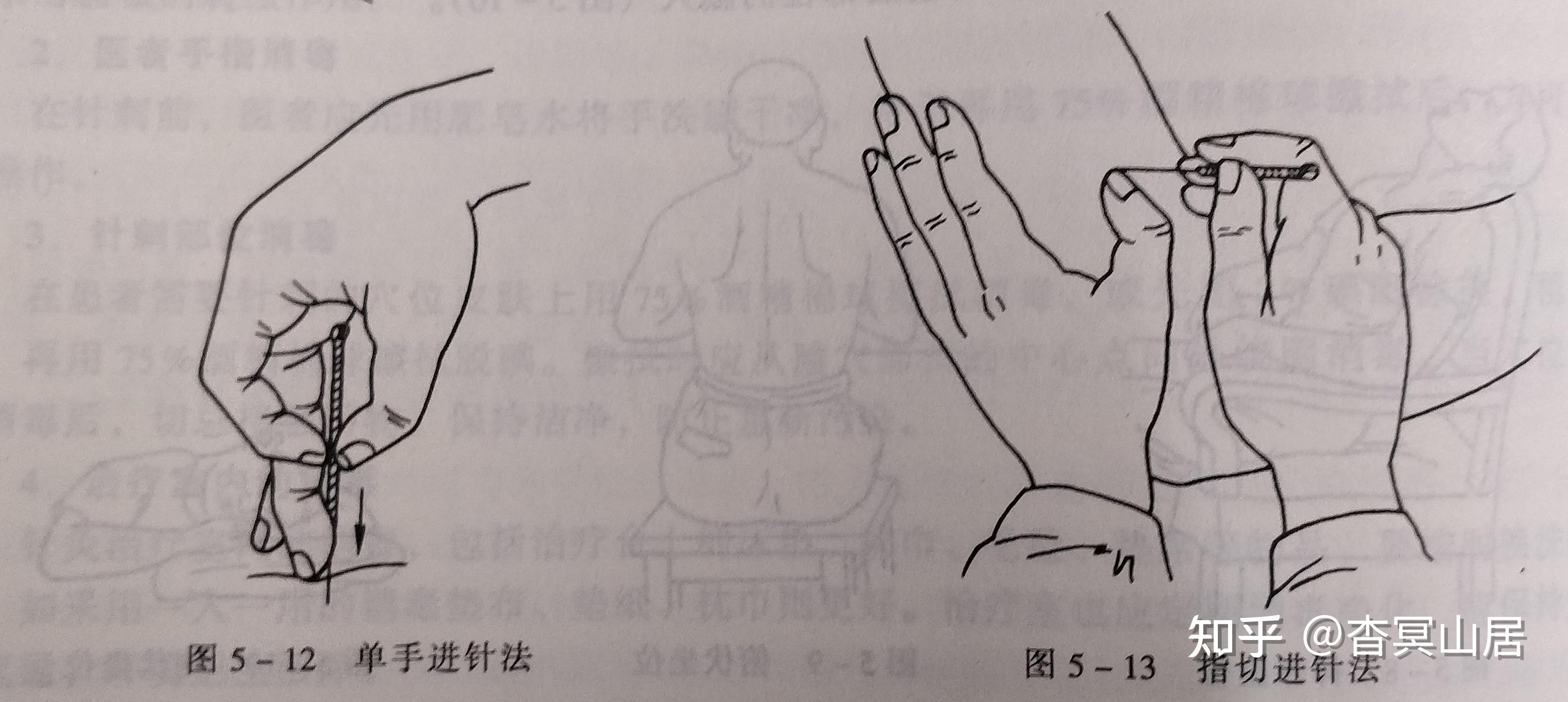 笔记摘要——针灸技术:毫针刺法、补泻原则与灸法概要 - 知乎