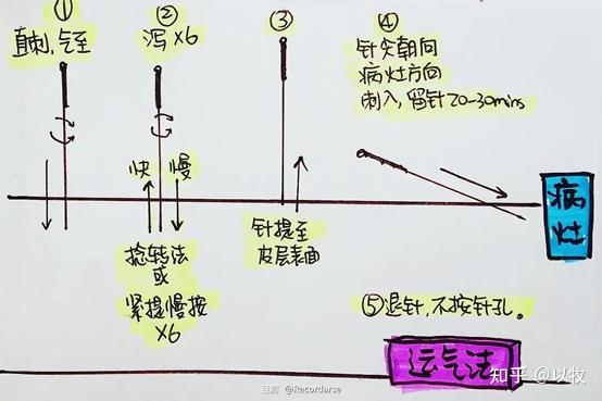 人纪针灸笔记(19)针刺法 - 知乎