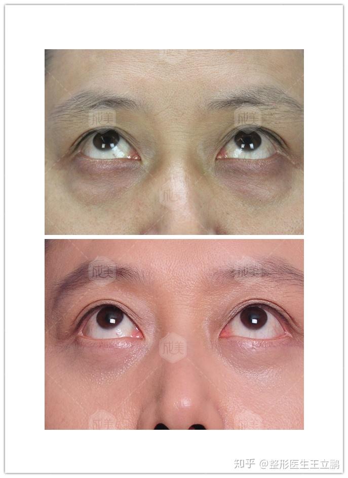 真性眼袋和假性眼袋有什么区别如何判断