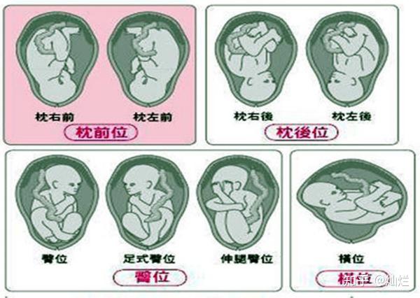 产时超声系列(文献翻译1)——ISUOG 实践指南:产时超声检查(2018年7月发表) - 知乎