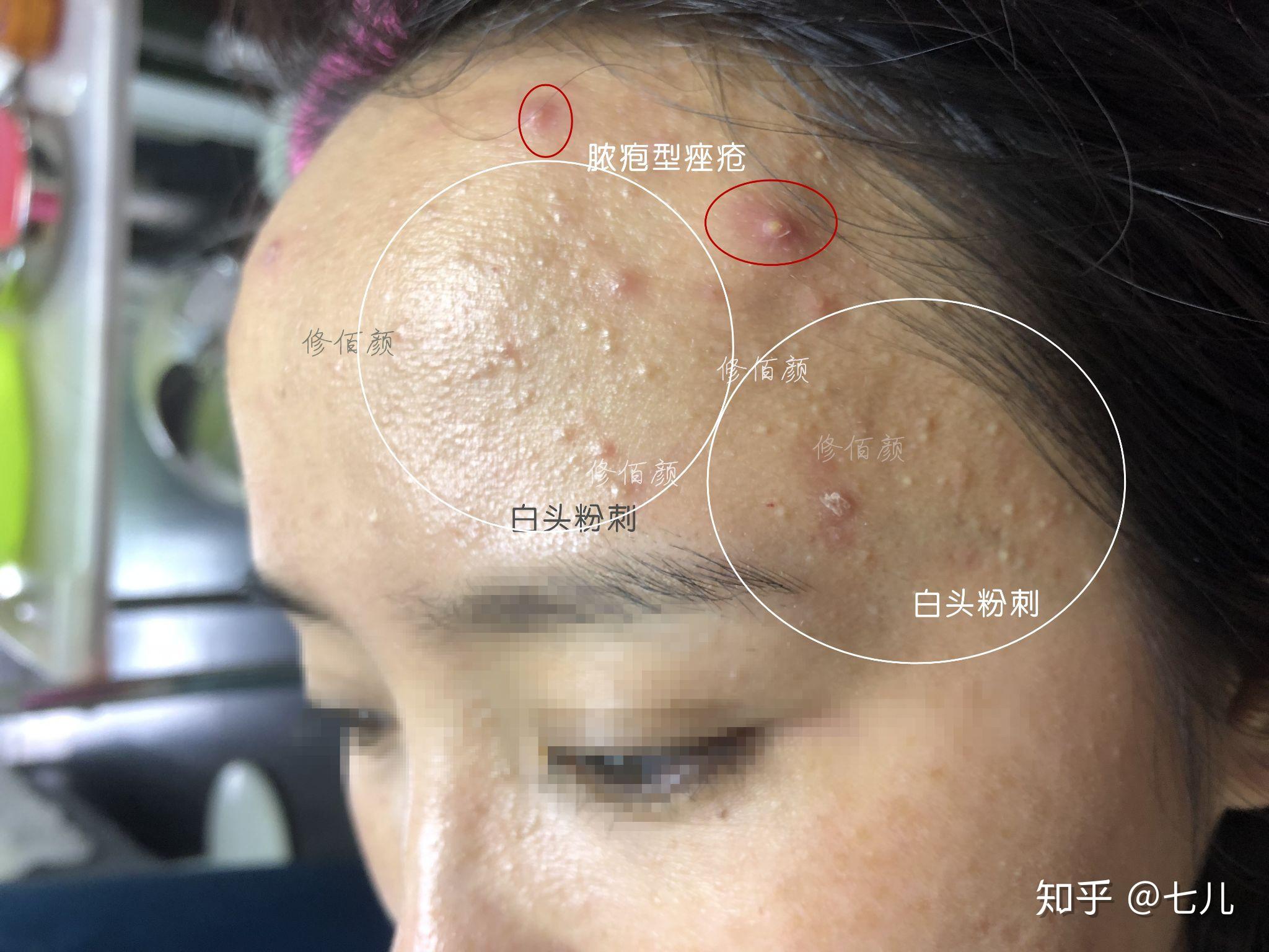 什么是粉刺,和闭口有什么区别? - 知乎