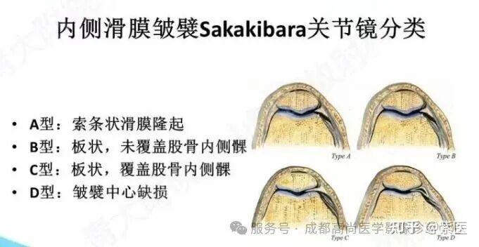 膝关节滑膜皱襞综合征(MPS)MR诊断 - 知乎