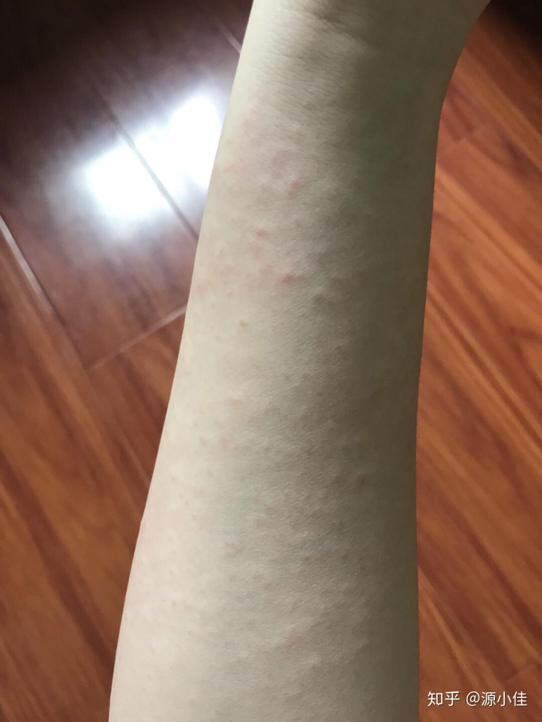 食物过敏为什么反应在面部皮肤上? - 知乎