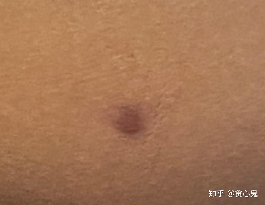 火疖子必须要开刀引流吗? - 知乎