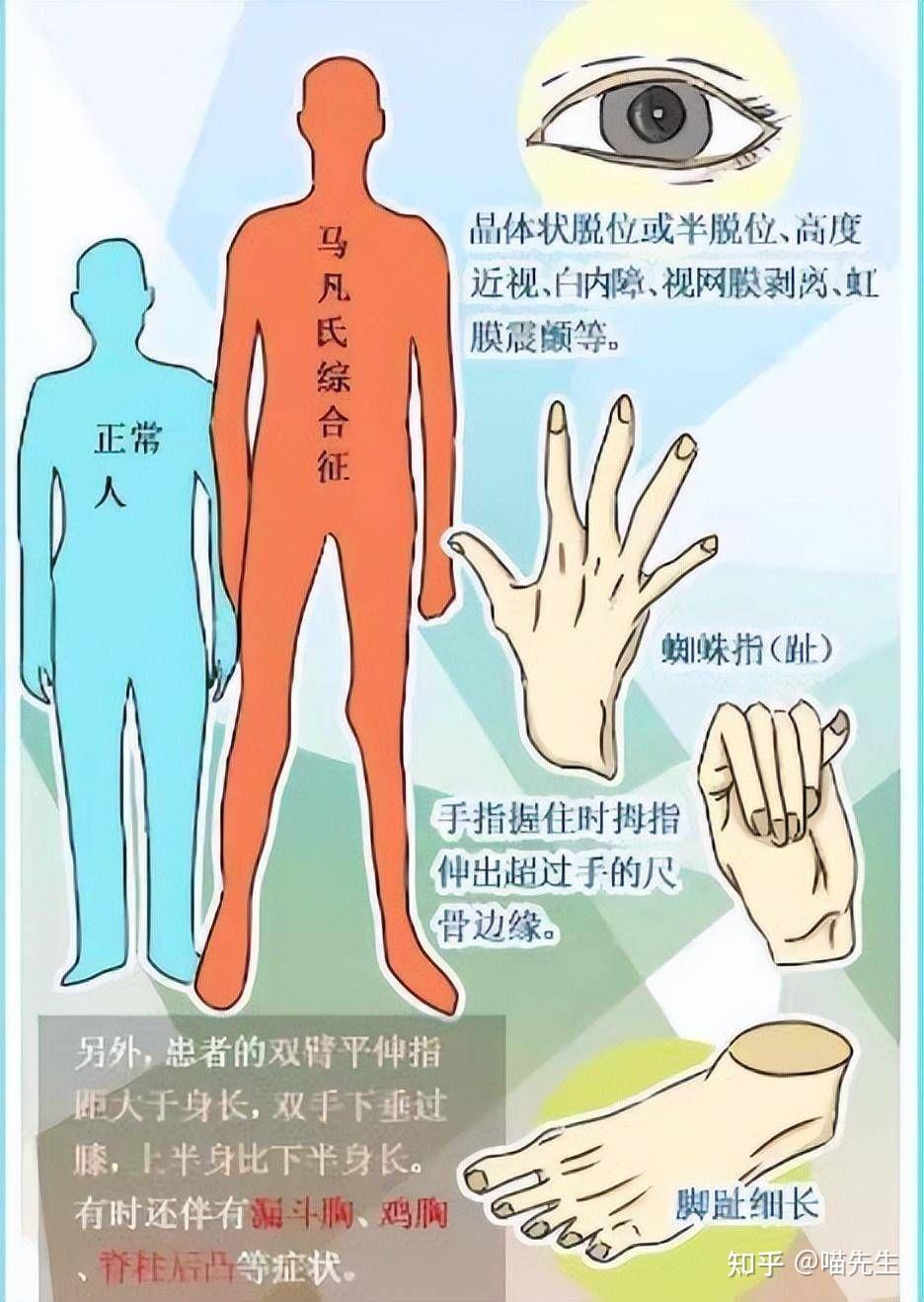 马方综合征（Marfan综合性） - 知乎