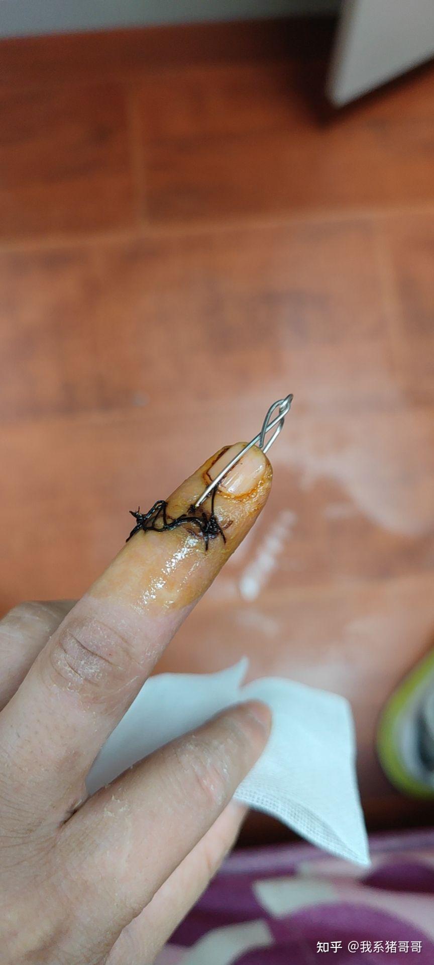 克氏针固定是一种什么体验,一般多久恢复? - 知乎