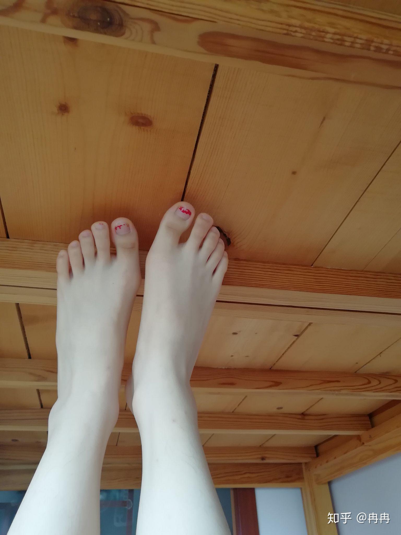 女生脚趾拇外翻是什么样体验