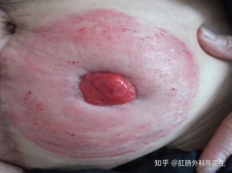 为什么说造口形态变化是造口渗漏的重要原因? - 知乎